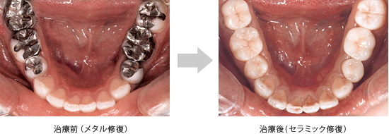 オールセラミック治療