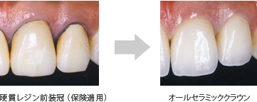 オールセラミック治療