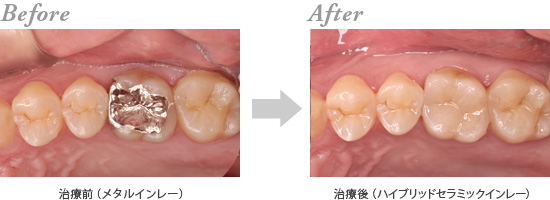 ハイブリッドセラミック治療