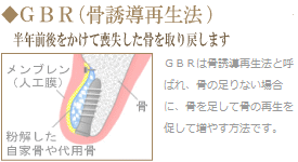 ＧＢＲ(骨誘導再生法)