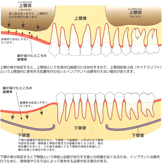 骨吸収