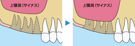 サイナスリフト