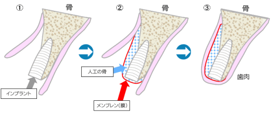 ＧＢＲ治療方法