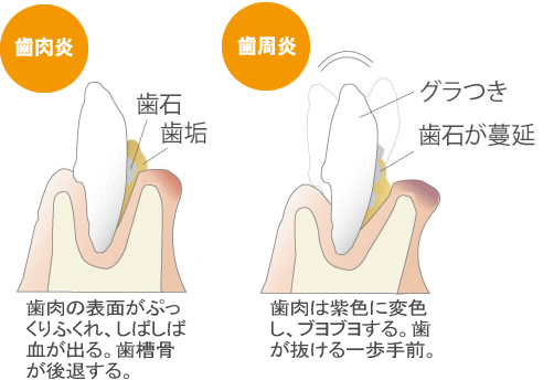 歯肉炎と歯周炎