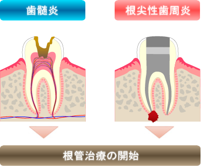 根管治療の開始