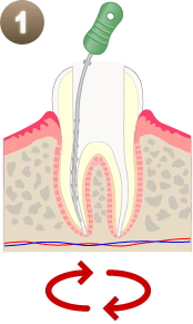 根管治療
