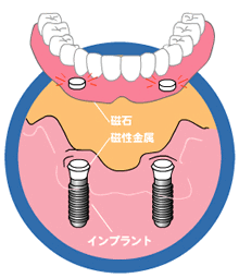 マグネットデンチャー