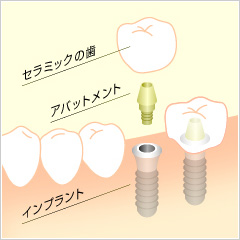 インプラント構造