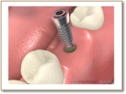 インプラントの埋入