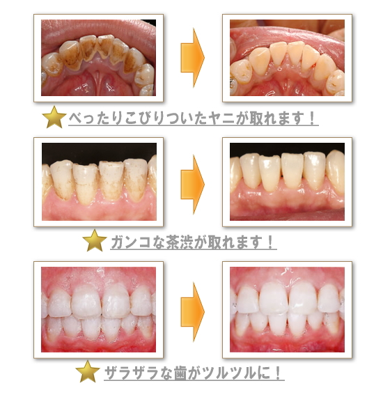 PMTCの効果