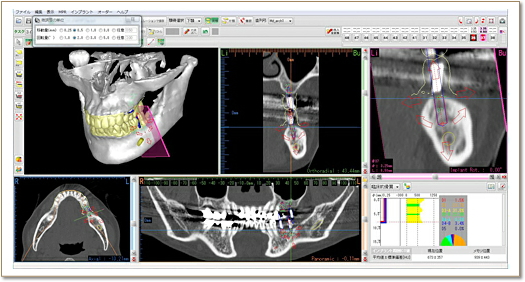 インプラント埋入シュミレーション